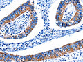 The image on the left is immunohistochemistry of paraffin-embedded Human colon cancer tissue using CSB-PA560952(CTSH Antibody) at dilution 1/5, on the right is treated with fusion protein. (Original magnification: ×200)