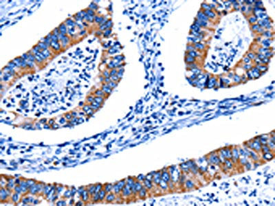 The image on the left is immunohistochemistry of paraffin-embedded Human colon cancer tissue using CSB-PA560952(CTSH Antibody) at dilution 1/5, on the right is treated with fusion protein. (Original magnification: ×200)