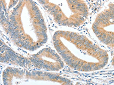 The image on the left is immunohistochemistry of paraffin-embedded Human colon cancer tissue using CSB-PA560972(CKAP2 Antibody) at dilution 1/50, on the right is treated with fusion protein. (Original magnification: ×200)