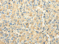 The image on the left is immunohistochemistry of paraffin-embedded Human liver cancer tissue using CSB-PA561188(EFNA3 Antibody) at dilution 1/25, on the right is treated with fusion protein. (Original magnification: ×200)
