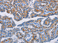 The image on the left is immunohistochemistry of paraffin-embedded Human thyroid cancer tissue using CSB-PA561279(BCL2A1 Antibody) at dilution 1/20, on the right is treated with fusion protein. (Original magnification: ×200)