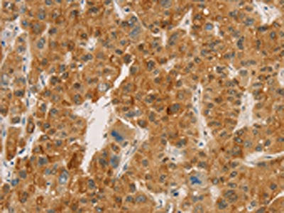 The image on the left is immunohistochemistry of paraffin-embedded Human liver cancer tissue using CSB-PA561433(CPA2 Antibody) at dilution 1/20, on the right is treated with fusion protein. (Original magnification: ×200)