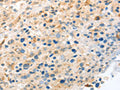 The image on the left is immunohistochemistry of paraffin-embedded Human ovarian cancer tissue using CSB-PA561582(LYVE1 Antibody) at dilution 1/20, on the right is treated with fusion protein. (Original magnification: ×200)