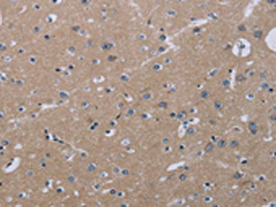 The image on the left is immunohistochemistry of paraffin-embedded Human brain tissue using CSB-PA561716(KLHL2 Antibody) at dilution 1/20, on the right is treated with fusion protein. (Original magnification: ×200)