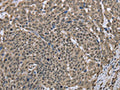 The image on the left is immunohistochemistry of paraffin-embedded Human cervical cancer tissue using CSB-PA561781(DCTN4 Antibody) at dilution 1/30, on the right is treated with fusion protein. (Original magnification: ×200)