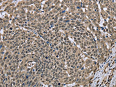 The image on the left is immunohistochemistry of paraffin-embedded Human cervical cancer tissue using CSB-PA561781(DCTN4 Antibody) at dilution 1/30, on the right is treated with fusion protein. (Original magnification: ×200)