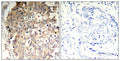 Immunohistochemical analysis of paraffin-embedded human breast carcinoma tissue using SHP-1(Phospho-Tyr536) Antibody(left) or the same antibody preincubated with blocking peptide(right).