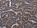 The image on the left is immunohistochemistry of paraffin-embedded Human thyroid cancer tissue using CSB-PA562259(KLK11 Antibody) at dilution 1/40, on the right is treated with fusion protein. (Original magnification: ×200)