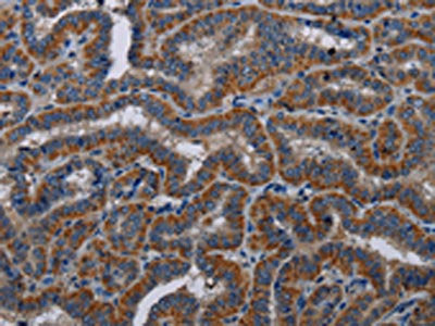 The image on the left is immunohistochemistry of paraffin-embedded Human thyroid cancer tissue using CSB-PA562259(KLK11 Antibody) at dilution 1/40, on the right is treated with fusion protein. (Original magnification: ×200)