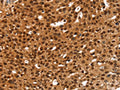 The image on the left is immunohistochemistry of paraffin-embedded Human breast cancer tissue using CSB-PA562564(ANKRD1 Antibody) at dilution 1/20, on the right is treated with fusion protein. (Original magnification: ×200)
