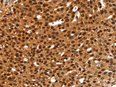 The image on the left is immunohistochemistry of paraffin-embedded Human breast cancer tissue using CSB-PA562564(ANKRD1 Antibody) at dilution 1/20, on the right is treated with fusion protein. (Original magnification: ×200)
