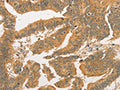 The image on the left is immunohistochemistry of paraffin-embedded Human colon cancer tissue using CSB-PA562697(BCL2L14 Antibody) at dilution 1/40, on the right is treated with fusion protein. (Original magnification: ×200)