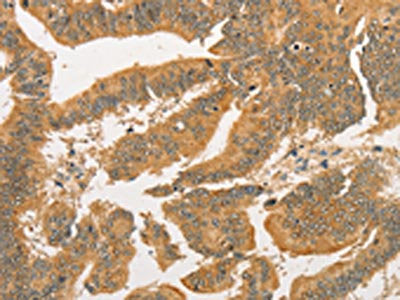 The image on the left is immunohistochemistry of paraffin-embedded Human colon cancer tissue using CSB-PA562697(BCL2L14 Antibody) at dilution 1/40, on the right is treated with fusion protein. (Original magnification: ×200)