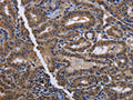 The image on the left is immunohistochemistry of paraffin-embedded Human thyroid cancer tissue using CSB-PA563111(CYP3A4 Antibody) at dilution 1/40, on the right is treated with fusion protein. (Original magnification: ×200)