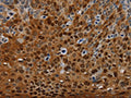 The image on the left is immunohistochemistry of paraffin-embedded Human cervical cancer tissue using CSB-PA563181(NRP2 Antibody) at dilution 1/35, on the right is treated with synthetic peptide. (Original magnification: ×200)