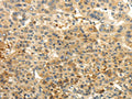 The image on the left is immunohistochemistry of paraffin-embedded Human liver cancer tissue using CSB-PA563243(CAMK1G Antibody) at dilution 1/30, on the right is treated with fusion protein. (Original magnification: ×200)