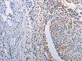 The image on the left is immunohistochemistry of paraffin-embedded Human lung cancer tissue using CSB-PA563679(STAT1 Antibody) at dilution 1/30, on the right is treated with fusion protein. (Original magnification: ×200)