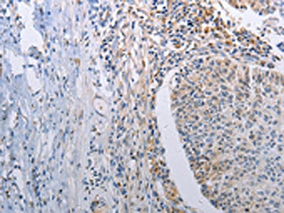 The image on the left is immunohistochemistry of paraffin-embedded Human lung cancer tissue using CSB-PA563679(STAT1 Antibody) at dilution 1/30, on the right is treated with fusion protein. (Original magnification: ×200)
