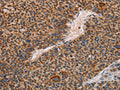 The image on the left is immunohistochemistry of paraffin-embedded Human liver cancer tissue using CSB-PA563995(MMP1 Antibody) at dilution 1/60, on the right is treated with fusion protein. (Original magnification: ×200)