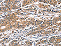 The image on the left is immunohistochemistry of paraffin-embedded Human gastic cancer tissue using CSB-PA564222(CAMK4 Antibody) at dilution 1/40, on the right is treated with fusion protein. (Original magnification: ×200)