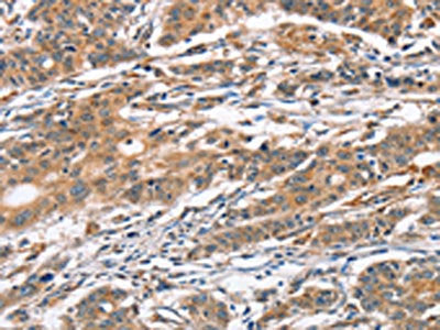 The image on the left is immunohistochemistry of paraffin-embedded Human gastic cancer tissue using CSB-PA564222(CAMK4 Antibody) at dilution 1/40, on the right is treated with fusion protein. (Original magnification: ×200)