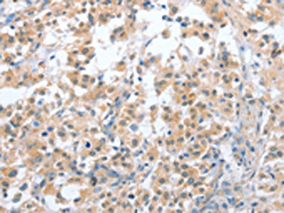 The image on the left is immunohistochemistry of paraffin-embedded Human thyroid cancer tissue using CSB-PA564323(CD200R1 Antibody) at dilution 1/70, on the right is treated with fusion protein. (Original magnification: ×200)