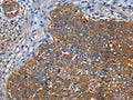 The image on the left is immunohistochemistry of paraffin-embedded Human cervical cancer tissue using CSB-PA564996(NT5E Antibody) at dilution 1/40, on the right is treated with fusion protein. (Original magnification: ×200)