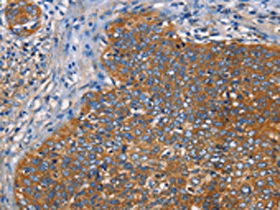 The image on the left is immunohistochemistry of paraffin-embedded Human cervical cancer tissue using CSB-PA564996(NT5E Antibody) at dilution 1/40, on the right is treated with fusion protein. (Original magnification: ×200)
