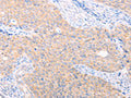 The image on the left is immunohistochemistry of paraffin-embedded Human cervical cancer tissue using CSB-PA565209(TRIM32 Antibody) at dilution 1/40, on the right is treated with fusion protein. (Original magnification: ×200)