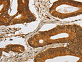 The image on the left is immunohistochemistry of paraffin-embedded Human colon cancer tissue using CSB-PA565390(SPHK2 Antibody) at dilution 1/80, on the right is treated with fusion protein. (Original magnification: ×200)