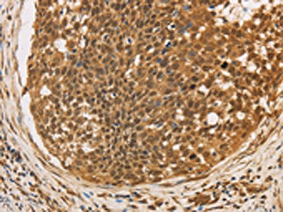 The image on the left is immunohistochemistry of paraffin-embedded Human cervical cancer tissue using CSB-PA565730(CXXC5 Antibody) at dilution 1/20, on the right is treated with fusion protein. (Original magnification: ×200)