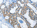 The image on the left is immunohistochemistry of paraffin-embedded Human thyroid cancer tissue using CSB-PA566307(ANKMY1 Antibody) at dilution 1/25, on the right is treated with fusion protein. (Original magnification: ×200)