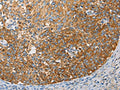 The image on the left is immunohistochemistry of paraffin-embedded Human cervical cancer tissue using CSB-PA566518(APOBEC3G Antibody) at dilution 1/50, on the right is treated with fusion protein. (Original magnification: ×200)