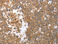 The image on the left is immunohistochemistry of paraffin-embedded Human breast cancer tissue using CSB-PA566766(MMP27 Antibody) at dilution 1/50, on the right is treated with synthetic peptide. (Original magnification: ×200)