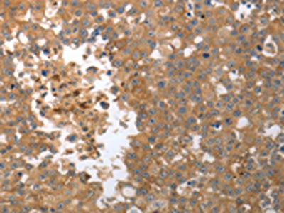 The image on the left is immunohistochemistry of paraffin-embedded Human breast cancer tissue using CSB-PA566766(MMP27 Antibody) at dilution 1/50, on the right is treated with synthetic peptide. (Original magnification: ×200)