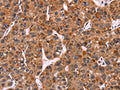 The image on the left is immunohistochemistry of paraffin-embedded Human liver cancer tissue using CSB-PA567327(CARD11 Antibody) at dilution 1/40, on the right is treated with fusion protein. (Original magnification: ×200)