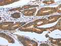 The image on the left is immunohistochemistry of paraffin-embedded Human colon cancer tissue using CSB-PA568085(PODXL Antibody) at dilution 1/25, on the right is treated with synthetic peptide. (Original magnification: ×200)