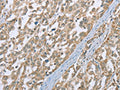 The image on the left is immunohistochemistry of paraffin-embedded Human esophagus cancer tissue using CSB-PA568195(ECHS1 Antibody) at dilution 1/35, on the right is treated with fusion protein. (Original magnification: ×200)