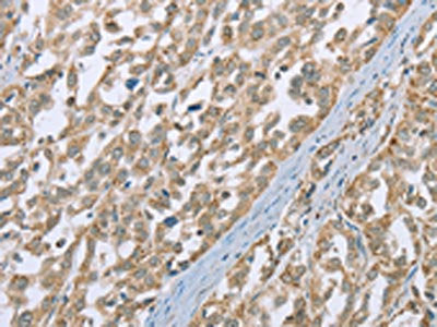 The image on the left is immunohistochemistry of paraffin-embedded Human esophagus cancer tissue using CSB-PA568195(ECHS1 Antibody) at dilution 1/35, on the right is treated with fusion protein. (Original magnification: ×200)