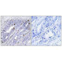 Immunohistochemistry analysis of paraffin-embedded human colon carcinoma tissue using Nuclear Receptor NR4A1 (Ab-351) antibody.