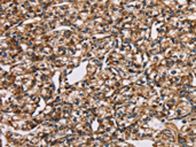 The image on the left is immunohistochemistry of paraffin-embedded Human prostate cancer tissue using CSB-PA568412(NDUFS1 Antibody) at dilution 1/35, on the right is treated with fusion protein. (Original magnification: ×200)