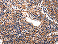 The image on the left is immunohistochemistry of paraffin-embedded Human lung cancer tissue using CSB-PA568452(HP Antibody) at dilution 1/25, on the right is treated with fusion protein. (Original magnification: ×200)