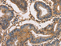 The image on the left is immunohistochemistry of paraffin-embedded Human colon cancer tissue using CSB-PA568564(HK3 Antibody) at dilution 1/40, on the right is treated with fusion protein. (Original magnification: ×200)