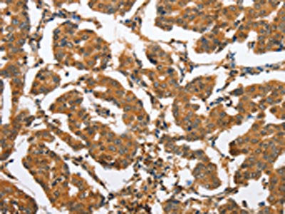 The image on the left is immunohistochemistry of paraffin-embedded Human breast cancer tissue using CSB-PA568771(CXCL14 Antibody) at dilution 1/60, on the right is treated with fusion protein. (Original magnification: ×200)