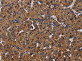 The image on the left is immunohistochemistry of paraffin-embedded Human liver cancer tissue using CSB-PA568879(LZTFL1 Antibody) at dilution 1/30, on the right is treated with fusion protein. (Original magnification: ×200)