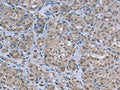 The image on the left is immunohistochemistry of paraffin-embedded Human thyroid cancer tissue using CSB-PA568889(FAR2 Antibody) at dilution 1/50, on the right is treated with fusion protein. (Original magnification: ×200)