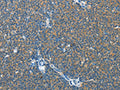 The image on the left is immunohistochemistry of paraffin-embedded Human lymphoma tissue using CSB-PA569374(IL13RA2 Antibody) at dilution 1/25, on the right is treated with fusion protein. (Original magnification: ×200)