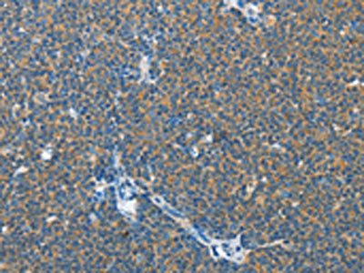 The image on the left is immunohistochemistry of paraffin-embedded Human lymphoma tissue using CSB-PA569374(IL13RA2 Antibody) at dilution 1/25, on the right is treated with fusion protein. (Original magnification: ×200)
