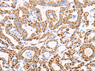 The image on the left is immunohistochemistry of paraffin-embedded Human thyroid cancer tissue using CSB-PA569426(ATPIF1 Antibody) at dilution 1/50, on the right is treated with fusion protein. (Original magnification: ×200)