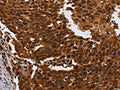 The image on the left is immunohistochemistry of paraffin-embedded Human cervical cancer tissue using CSB-PA569454(FANCF Antibody) at dilution 1/60, on the right is treated with fusion protein. (Original magnification: ×200)
